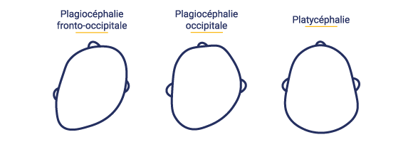 plagiocéphalie enfant, tête plate, ostéopathe lausanne