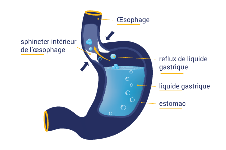 ostéopathe lausanne nourrisson bébé reflux gastro-œsophagien